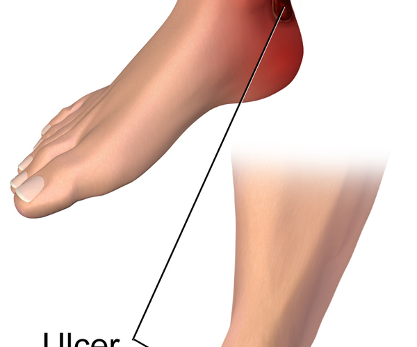 9 Simple tips to prevent diabetic leg ulcers.