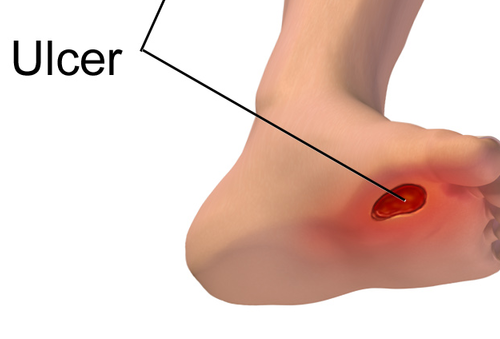9 Simple tips to prevent diabetic leg ulcers.