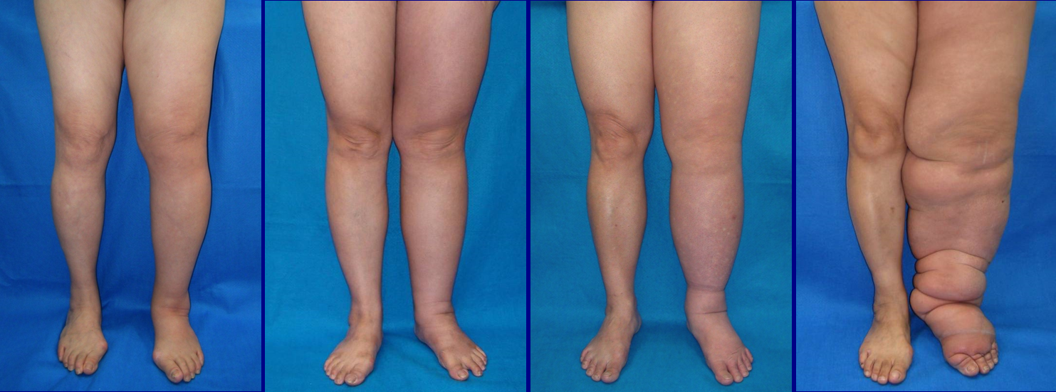 Lower Limb Lymphedema and its 4 stages