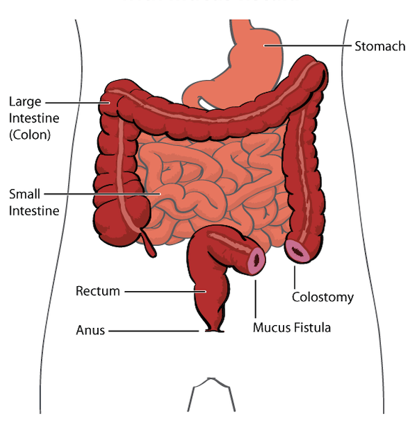 diagram showing colostomy
