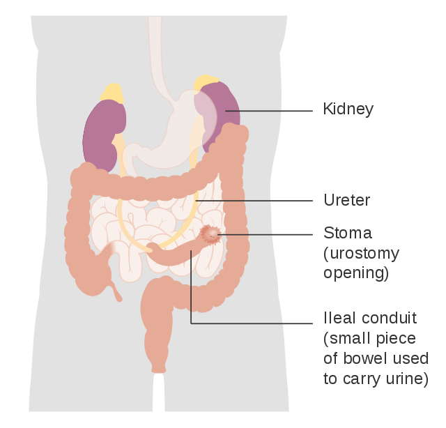diagram showing urostomy